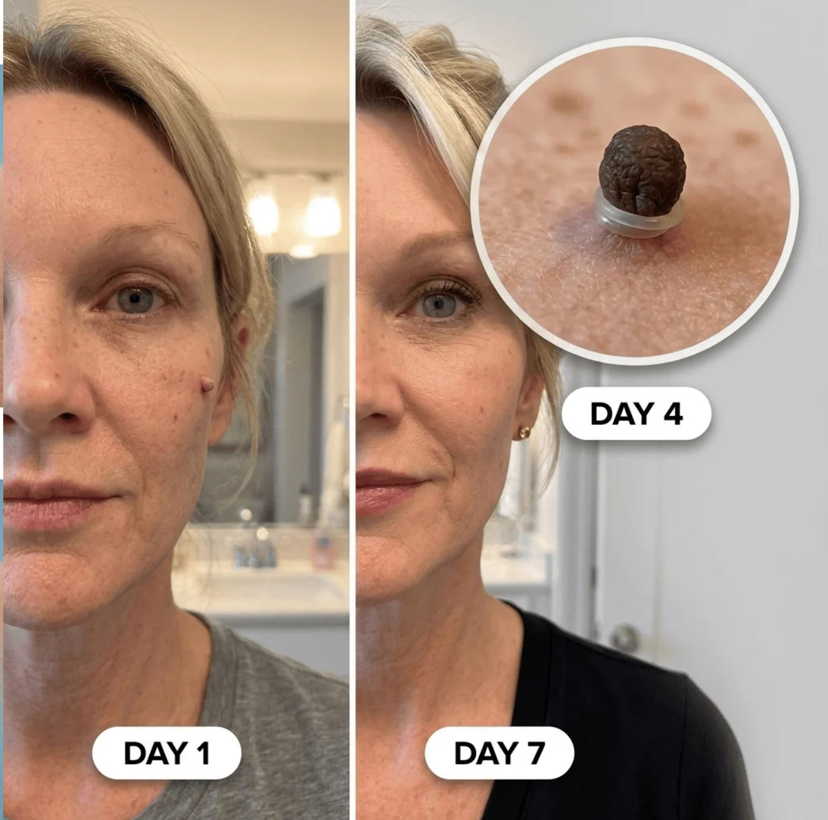 Lunova Clear Skin Tag Remover Kit