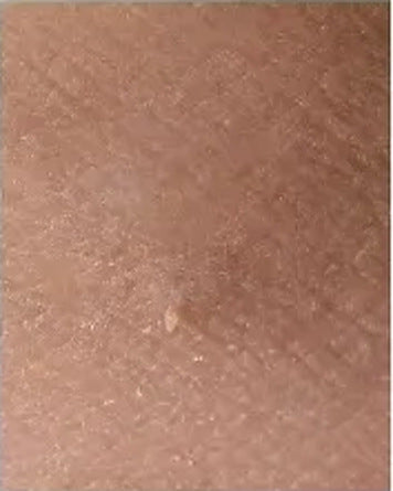 The same spot after the tag has come away